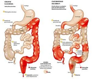 Esquema comparativo de colitis ulcerosa y enfermedad de Crohn, con las zonas afectadas del aparato digestivo resaltadas en rojo. Esquema comparativo de colitis ulcerosa y enfermedad de Crohn, con las zonas afectadas del aparato digestivo resaltadas en rojo.